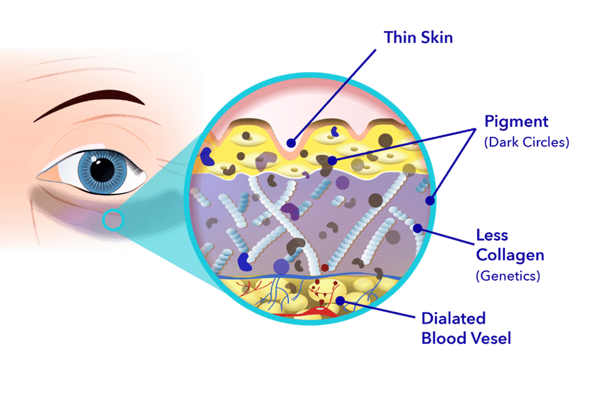 Causes of Dark Circles Under the Eyes