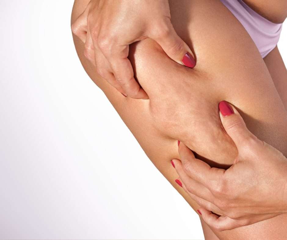 The Causes and Treatment of Cellulite