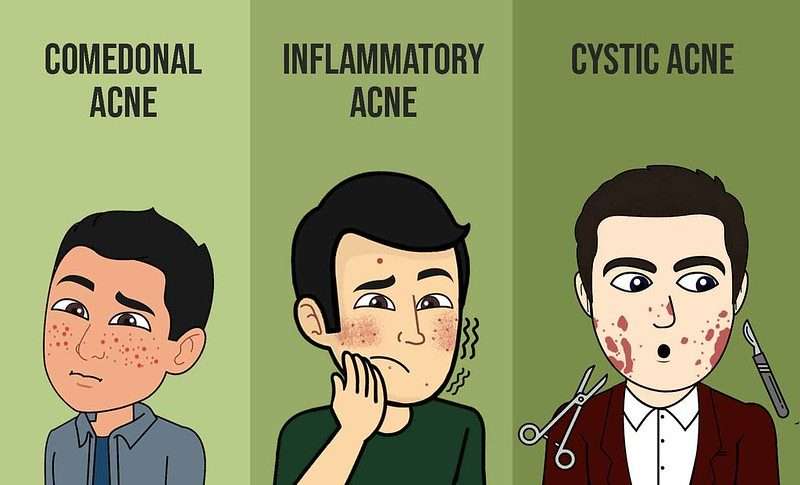 Understanding Acne: Causes, Symptoms, and Treatment Options